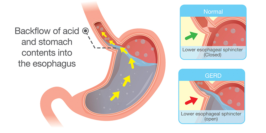 Gerd Hiatal Hernia Nusagates
